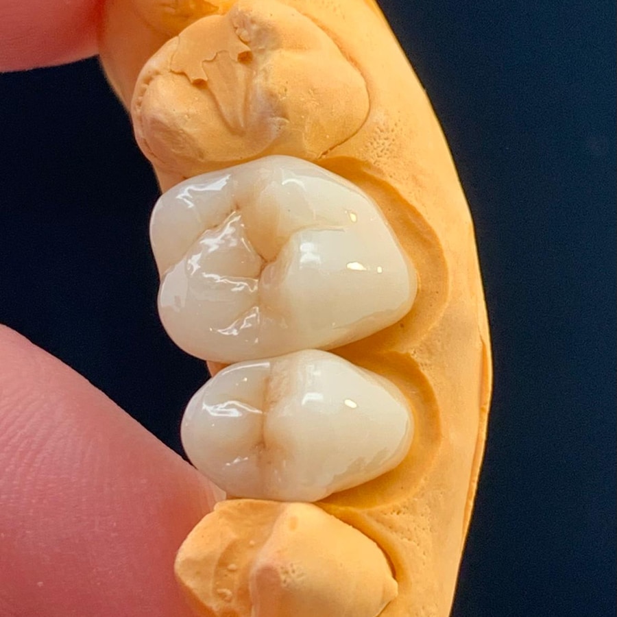 Zahnersatz - Zahnärztin Faour in Hamburg Barmbek